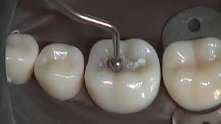 Class I Amalgam Preparation amp Restoration  Operative Dentistry [upl. by Dorcus]