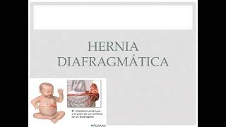 Hernia diafragmática congénita [upl. by Yesnel]