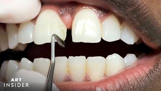 How Tooth Gaps Are Filled  Insider Art [upl. by Alliuqa]