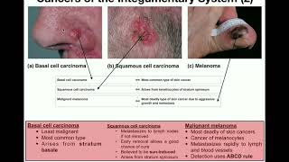 Choosing the Right Treatment for Cutaneous Tcell Lymphomas [upl. by Lednek]