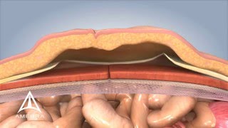 Ventral Hernia Repair  3D Medical Animation [upl. by Esinyt]